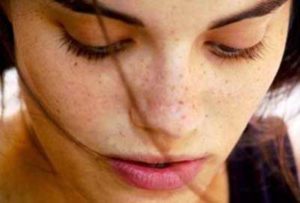چطور لکه های قهوه ای را درمان کنیم