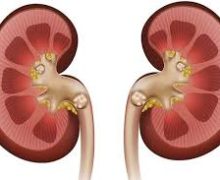 سنگهای کلیوی