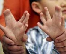 ناهنجاریهای مادرزادی